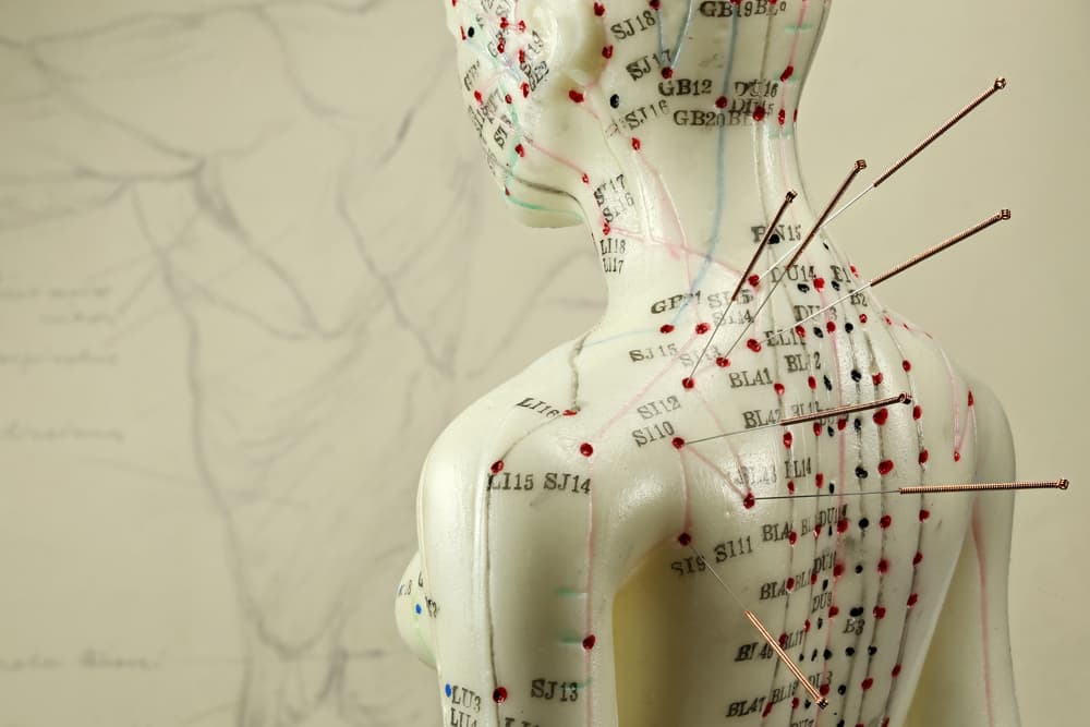 How to Know if Acupuncture Is Right for You