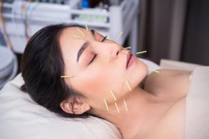 acupuncture needles on the face